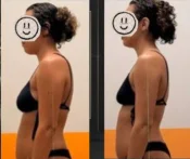 Antes e depois de postura, vista de perfil